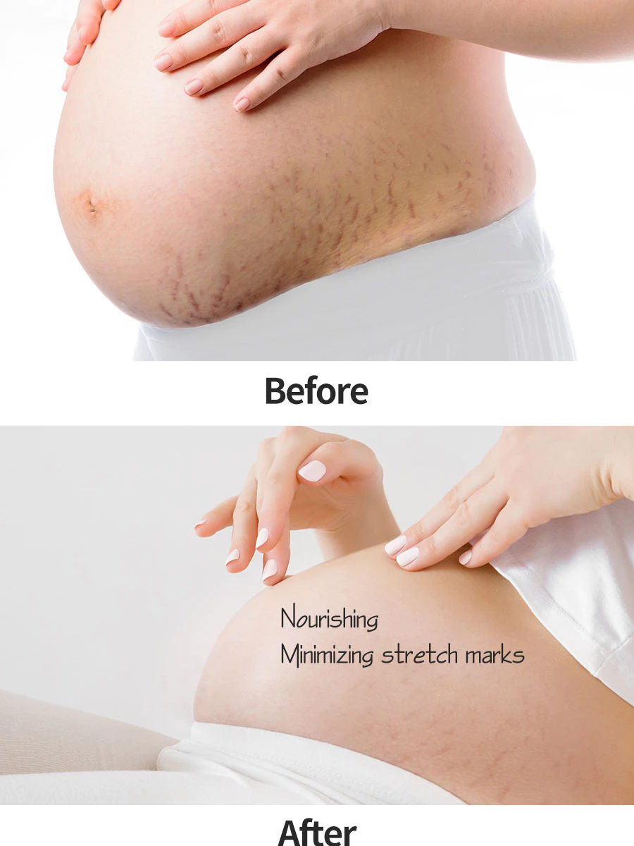 Mamaway Body Treatment Oil 100ml | Stretch Mark Oil Prevention