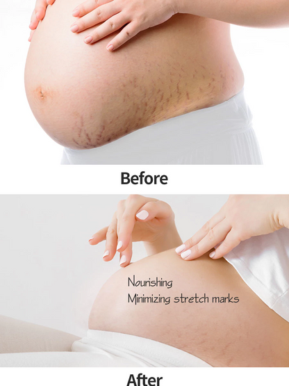 Mamaway Body Treatment Oil 100ml | Stretch Mark Oil Prevention